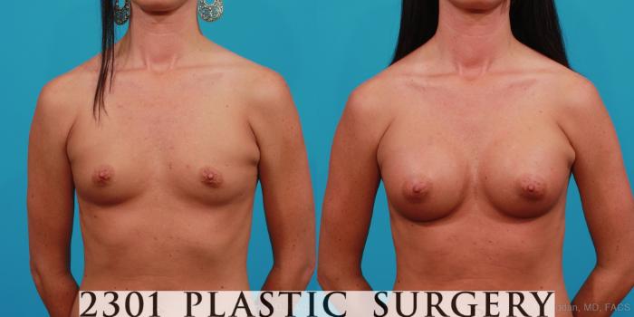 Before & After Silicone Implants Case 347 View #1 View in Fort Worth, Plano, & Frisco, Texas