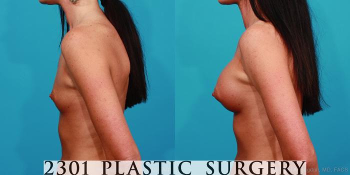 Before & After Silicone Implants Case 347 View #2 View in Fort Worth, Plano, & Frisco, Texas