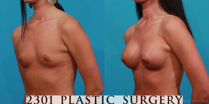 Before & After Silicone Implants Case 347 View #3 View in Fort Worth, Plano, & Frisco, Texas