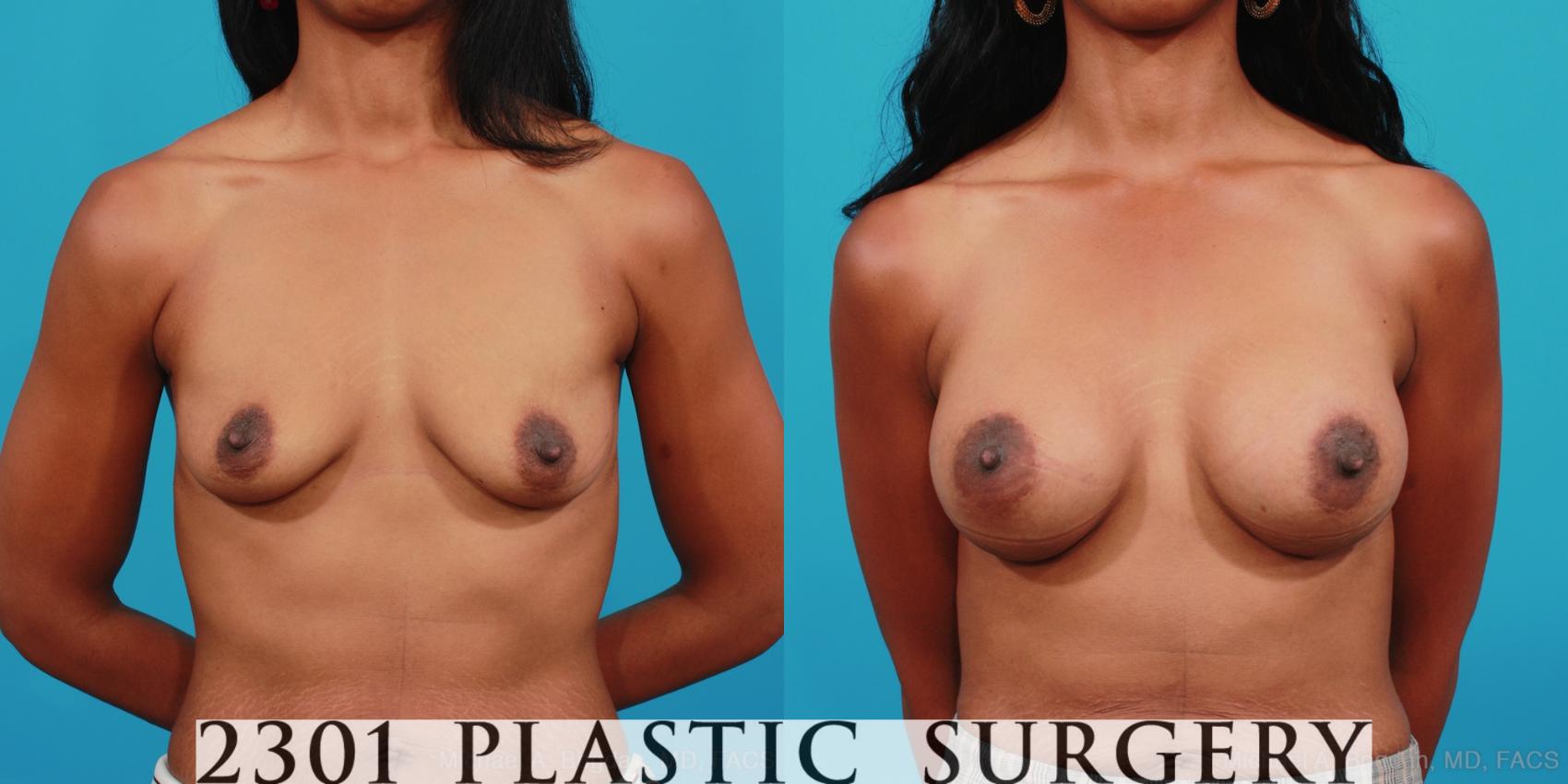 Before & After Breast Augmentation Case 348 View #1 View in Fort Worth, Plano, & Frisco, Texas