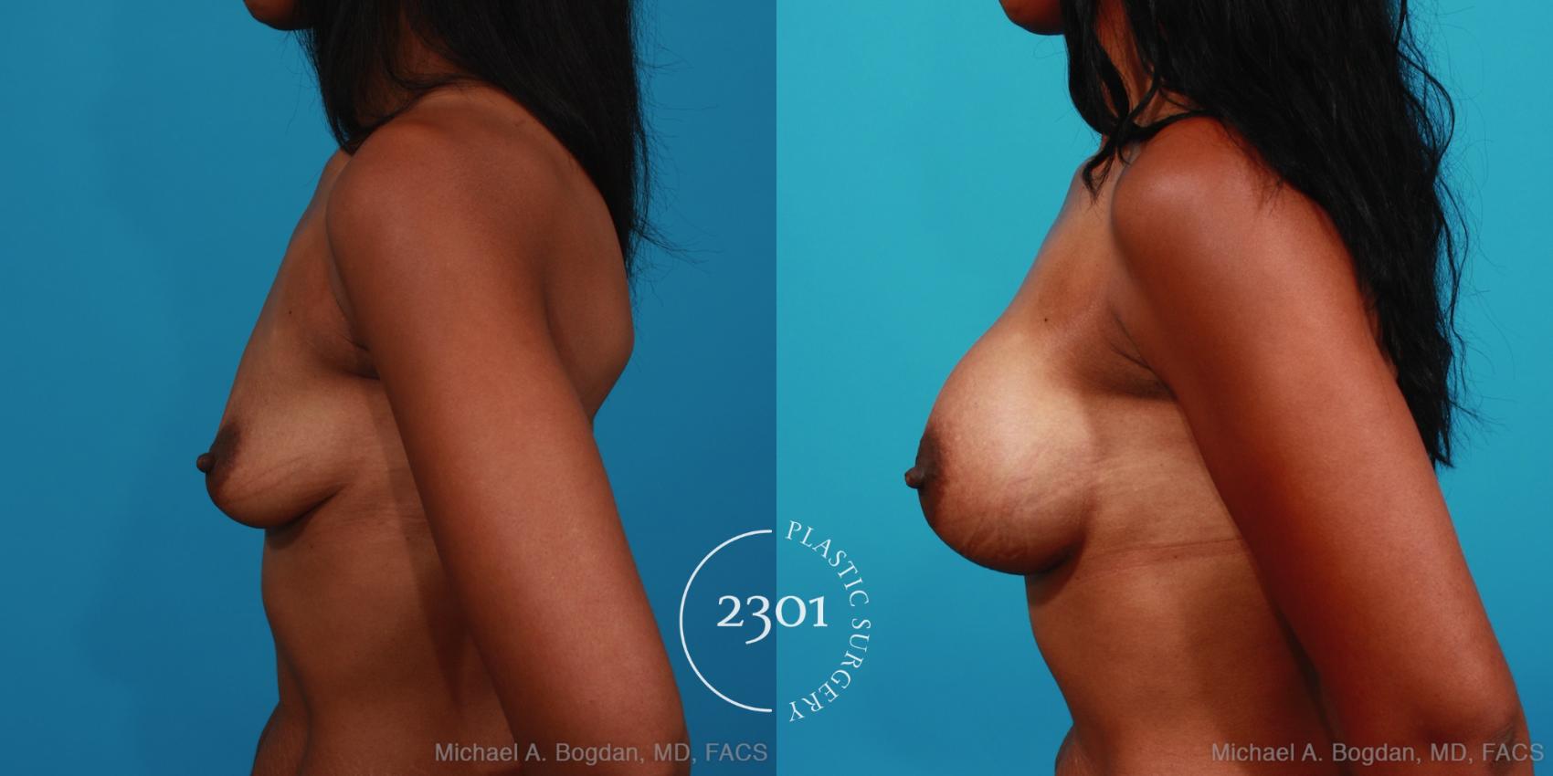 Before & After Silicone Implants Case 348 View #2 View in Fort Worth, Plano, & Frisco, Texas