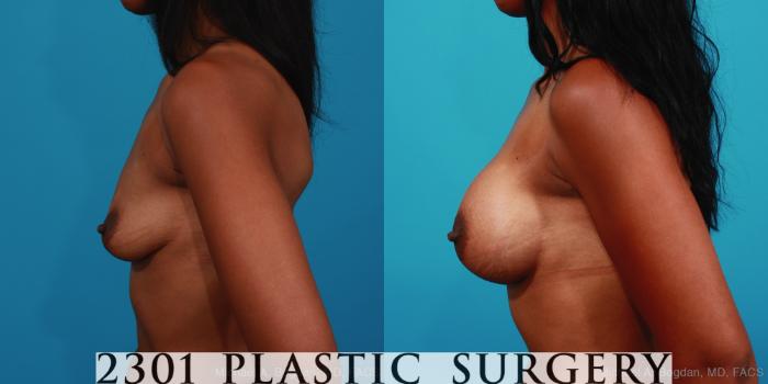 Before & After Silicone Implants Case 348 View #2 View in Fort Worth, Plano, & Frisco, Texas