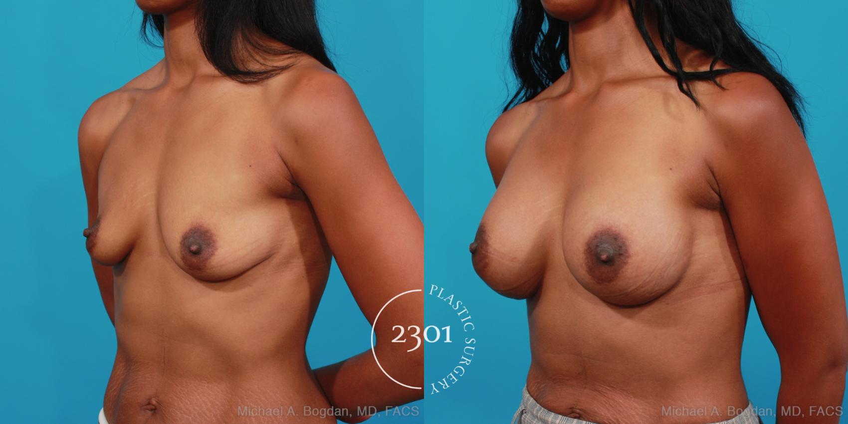 Before & After Silicone Implants Case 348 View #3 View in Fort Worth, Plano, & Frisco, Texas