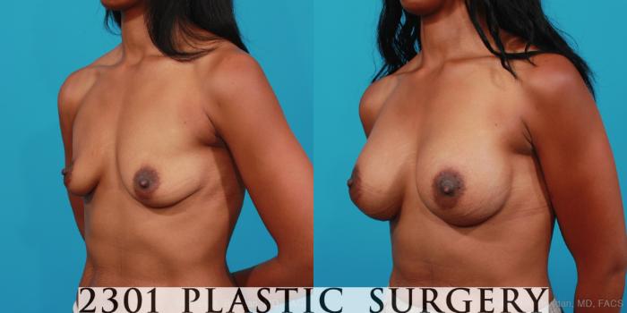 Before & After Silicone Implants Case 348 View #3 View in Fort Worth, Plano, & Frisco, Texas