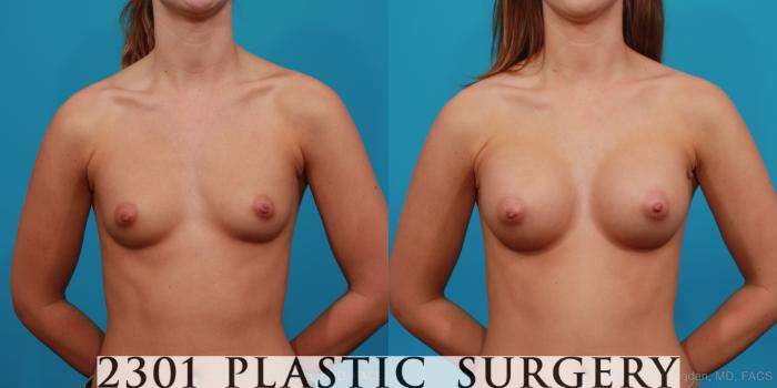 Before & After Silicone Implants Case 349 View #1 View in Fort Worth, Plano, & Frisco, Texas
