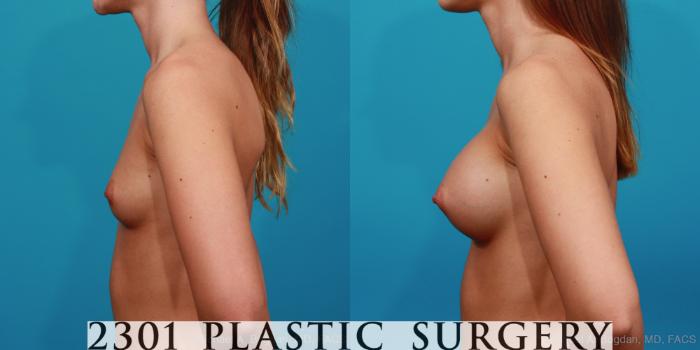 Before & After Silicone Implants Case 349 View #2 View in Fort Worth, Plano, & Frisco, Texas