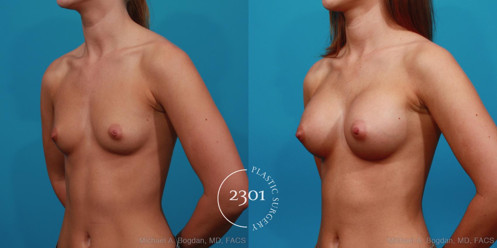 Before & After Silicone Implants Case 349 View #3 View in Fort Worth, Plano, & Frisco, Texas