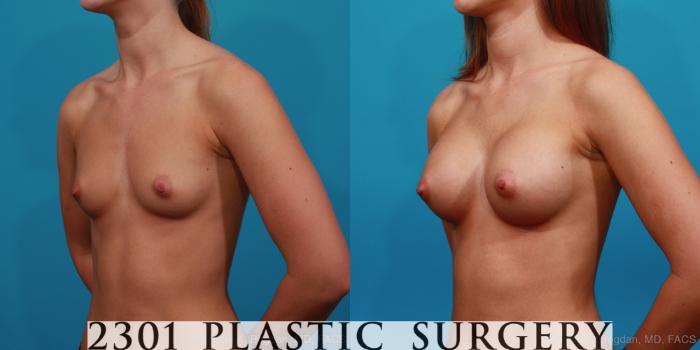 Before & After Silicone Implants Case 349 View #3 View in Fort Worth, Plano, & Frisco, Texas