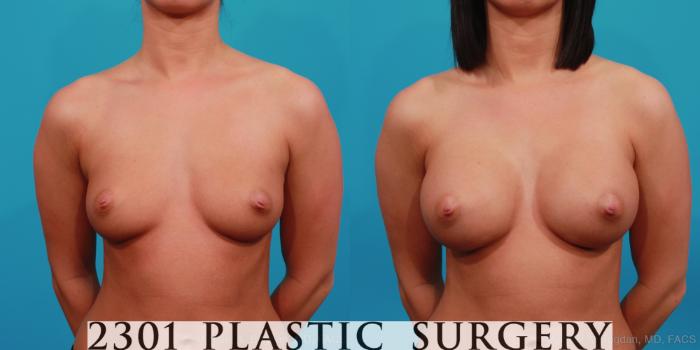 Before & After Silicone Implants Case 351 View #1 View in Fort Worth, Plano, & Frisco, Texas