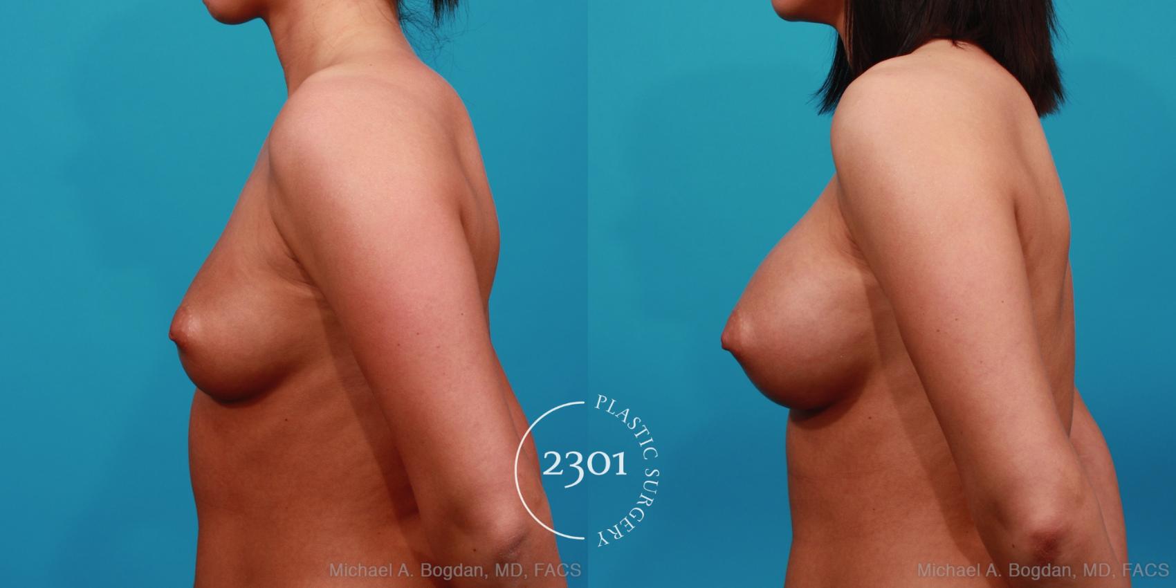 Before & After Silicone Implants Case 351 View #2 View in Fort Worth, Plano, & Frisco, Texas