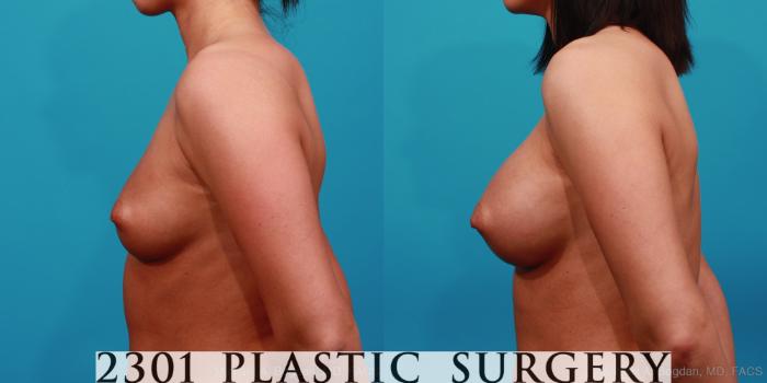 Before & After Silicone Implants Case 351 View #2 View in Fort Worth, Plano, & Frisco, Texas