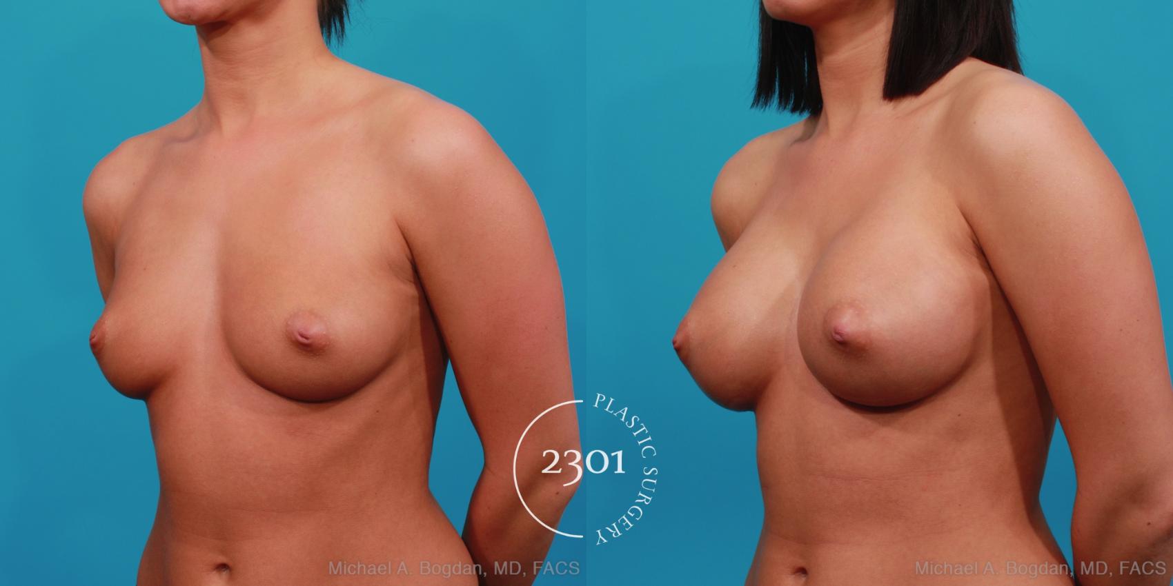 Before & After Silicone Implants Case 351 View #3 View in Fort Worth, Plano, & Frisco, Texas