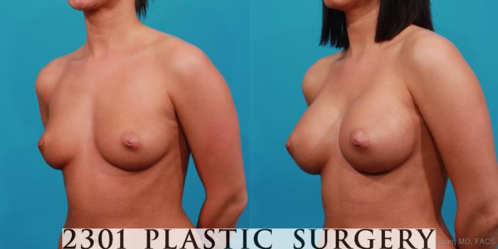 Before & After Silicone Implants Case 351 View #3 View in Fort Worth, Plano, & Frisco, Texas