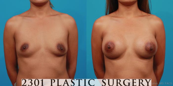 Before & After Silicone Implants Case 354 View #1 View in Fort Worth, Plano, & Frisco, Texas