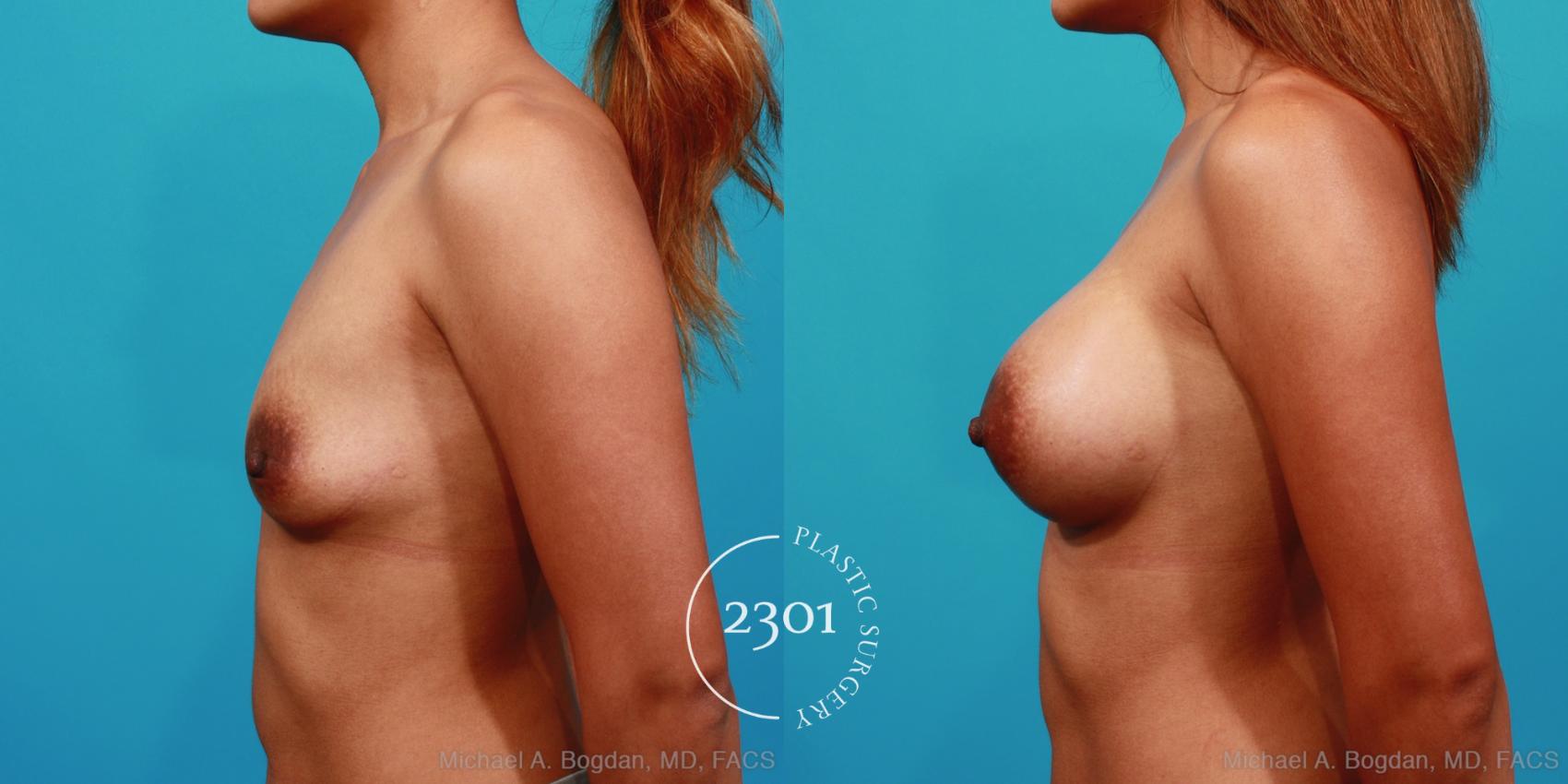 Before & After Silicone Implants Case 354 View #2 View in Fort Worth, Plano, & Frisco, Texas