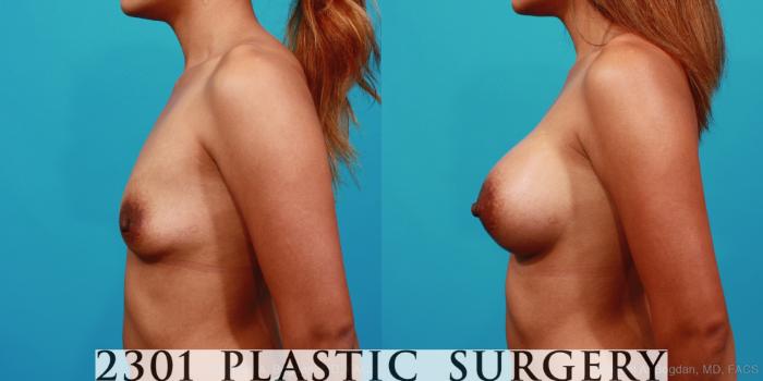 Before & After Silicone Implants Case 354 View #2 View in Fort Worth, Plano, & Frisco, Texas
