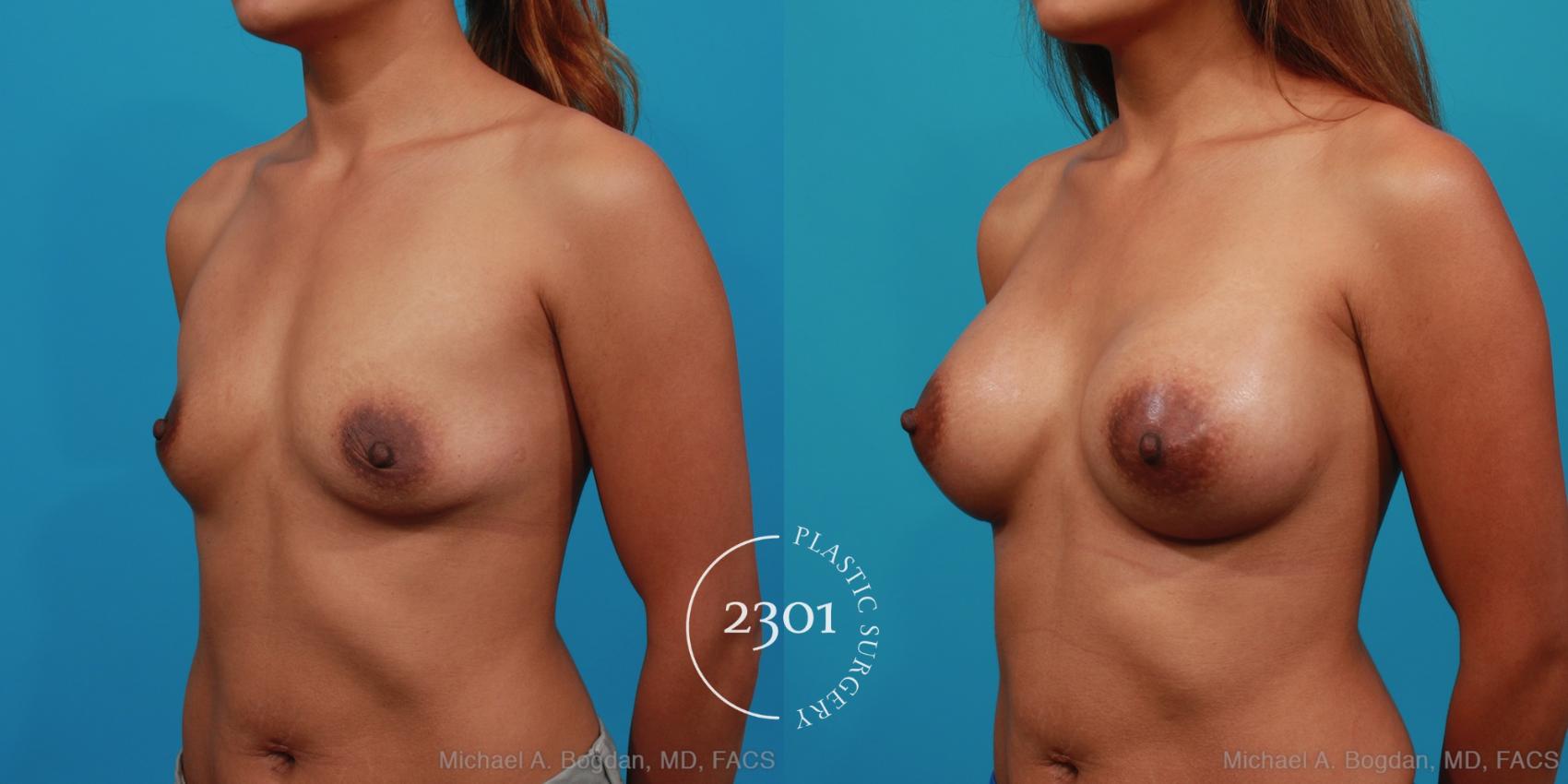 Before & After Silicone Implants Case 354 View #3 View in Fort Worth, Plano, & Frisco, Texas