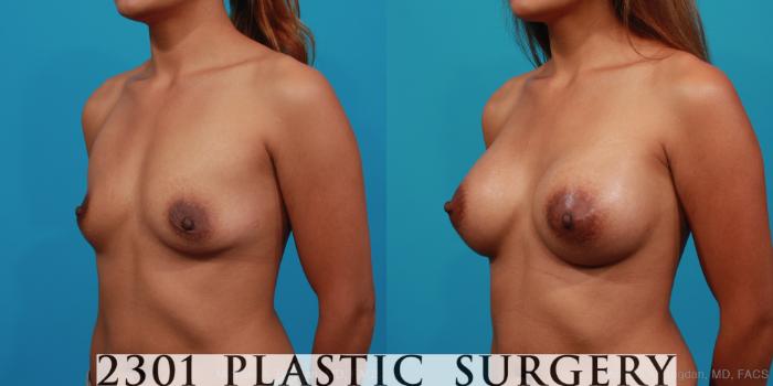Before & After Silicone Implants Case 354 View #3 View in Fort Worth, Plano, & Frisco, Texas