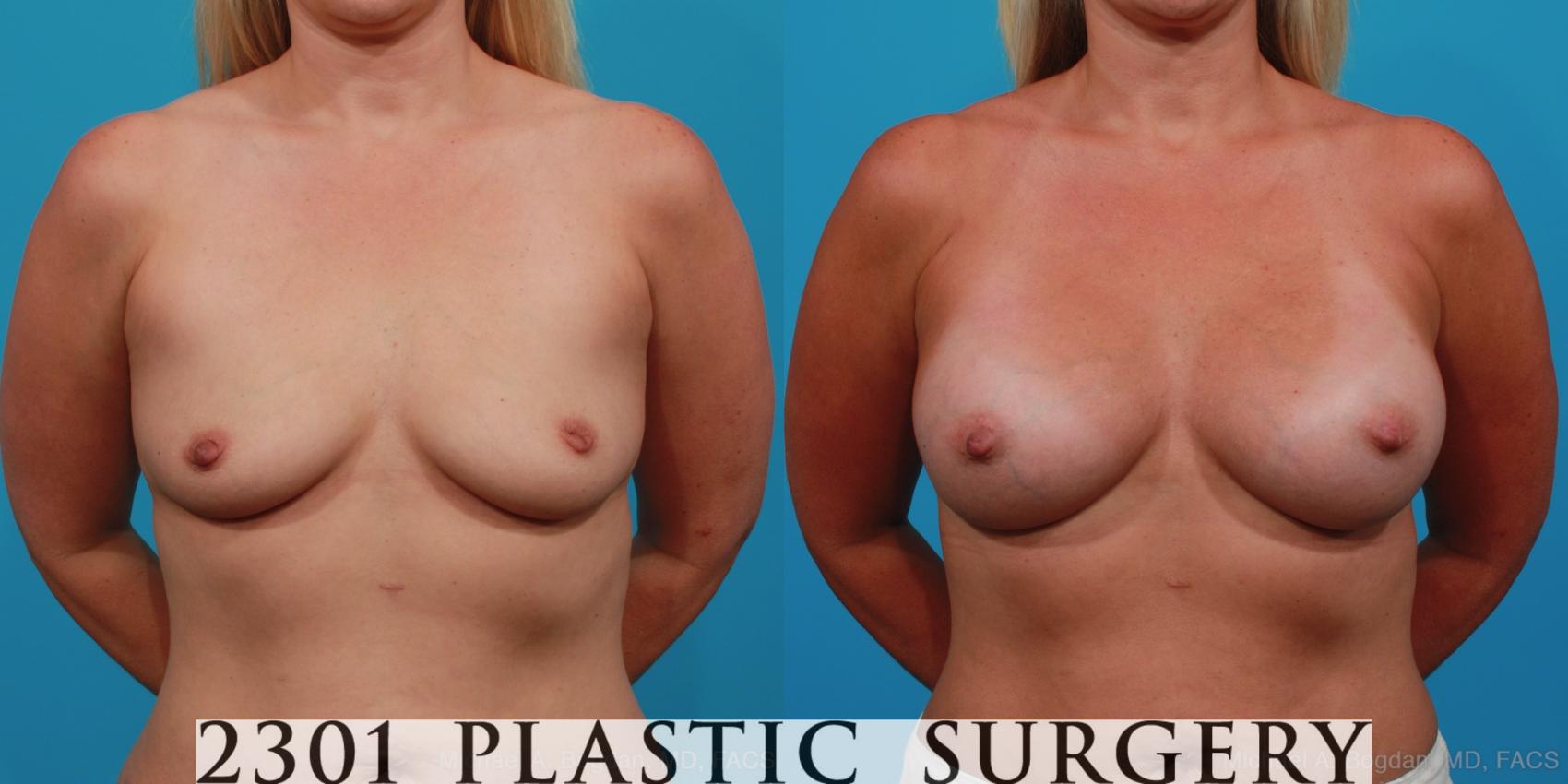 Before & After Silicone Implants Case 355 View #1 View in Fort Worth, Plano, & Frisco, Texas