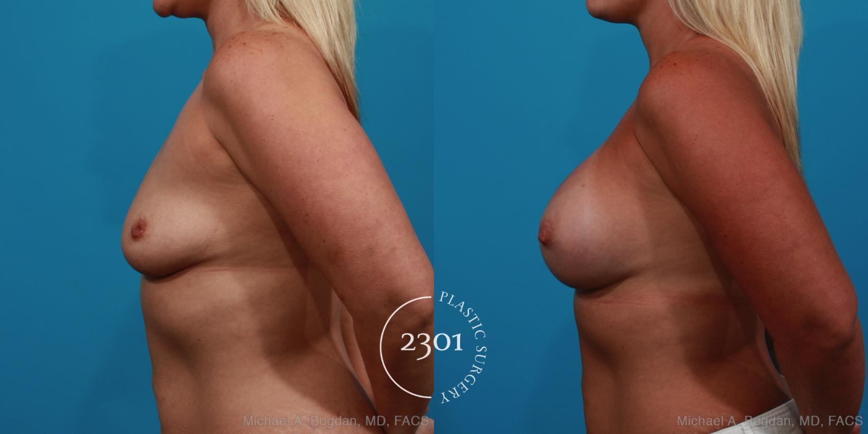 Before & After Silicone Implants Case 355 View #2 View in Fort Worth, Plano, & Frisco, Texas