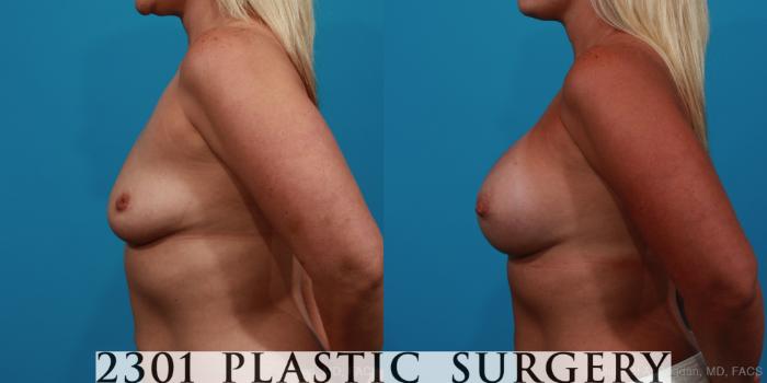 Before & After Silicone Implants Case 355 View #2 View in Fort Worth, Plano, & Frisco, Texas