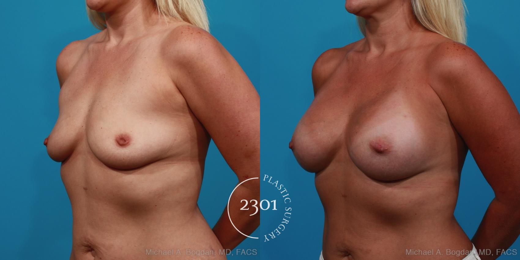 Before & After Silicone Implants Case 355 View #3 View in Fort Worth, Plano, & Frisco, Texas