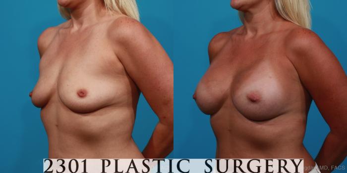 Before & After Silicone Implants Case 355 View #3 View in Fort Worth, Plano, & Frisco, Texas