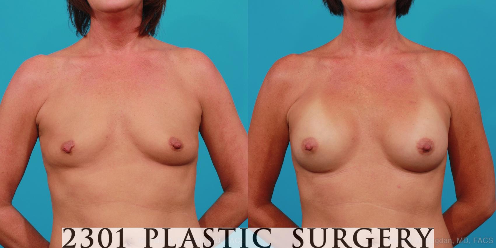 Before & After Silicone Implants Case 357 View #1 View in Fort Worth, Plano, & Frisco, Texas