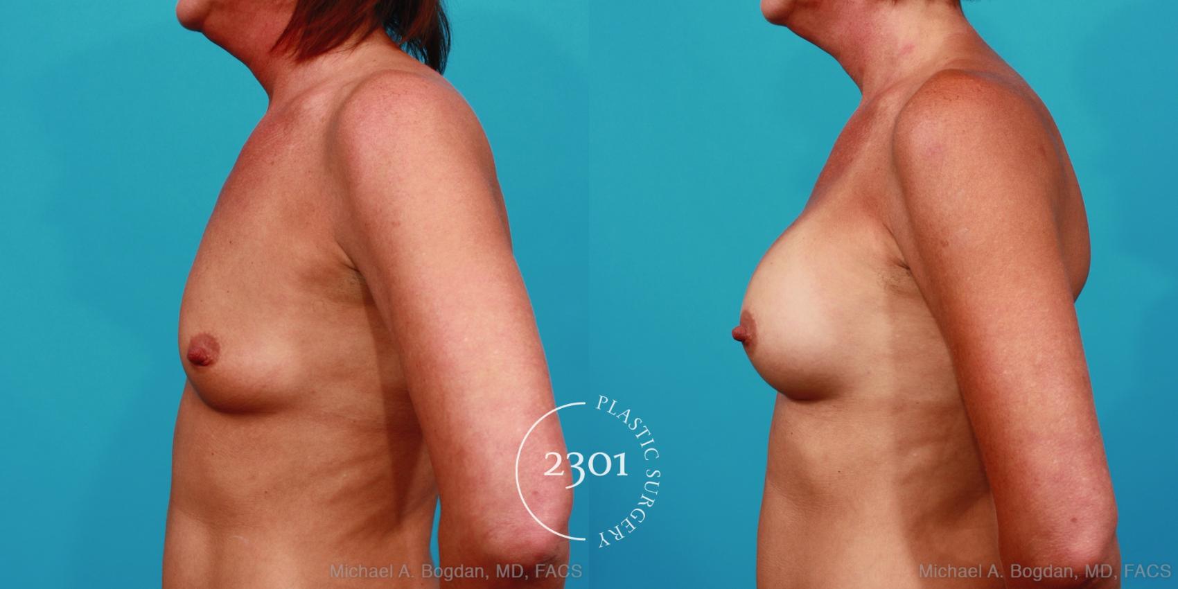 Before & After Silicone Implants Case 357 View #2 View in Fort Worth, Plano, & Frisco, Texas