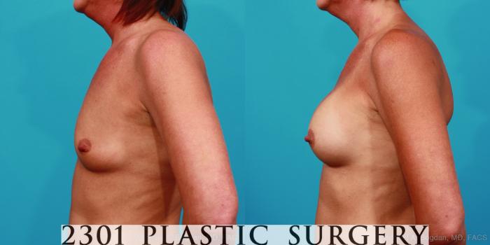 Before & After Silicone Implants Case 357 View #2 View in Fort Worth, Plano, & Frisco, Texas