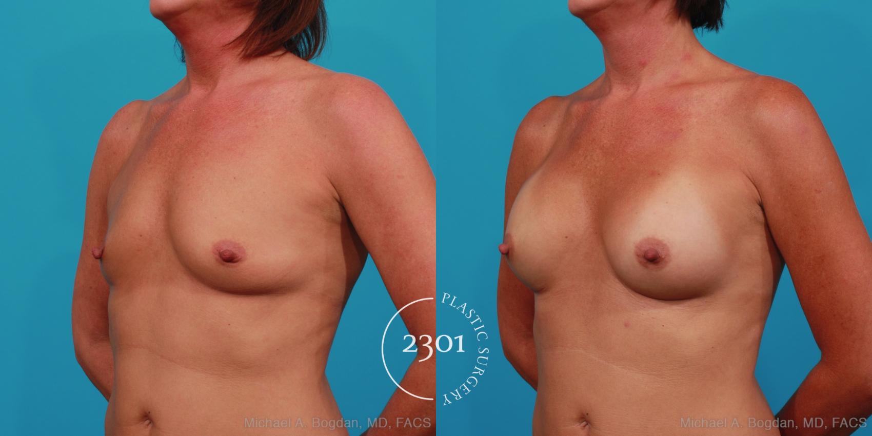Before & After Silicone Implants Case 357 View #3 View in Fort Worth, Plano, & Frisco, Texas