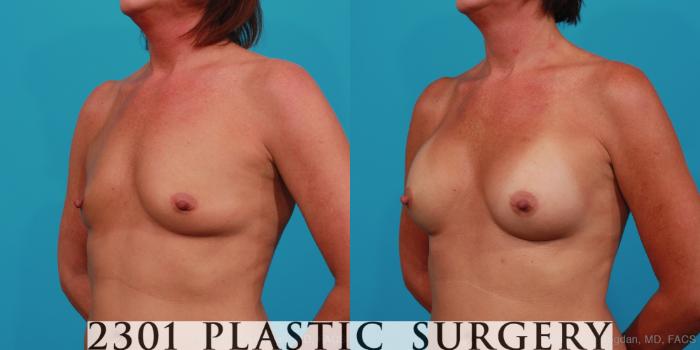Before & After Silicone Implants Case 357 View #3 View in Fort Worth, Plano, & Frisco, Texas
