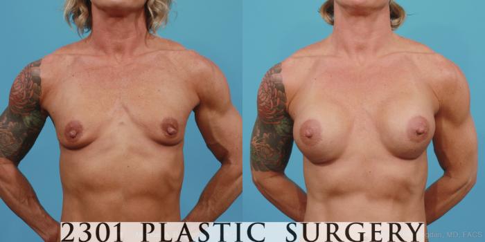 Before & After Silicone Implants Case 360 View #1 View in Fort Worth, Plano, & Frisco, Texas