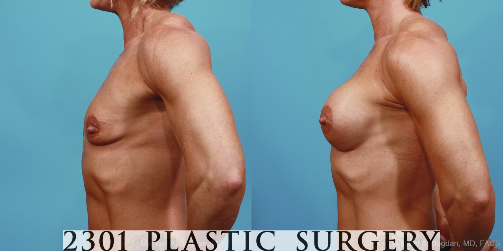 Before & After Silicone Implants Case 360 View #2 View in Fort Worth & Frisco, Texas
