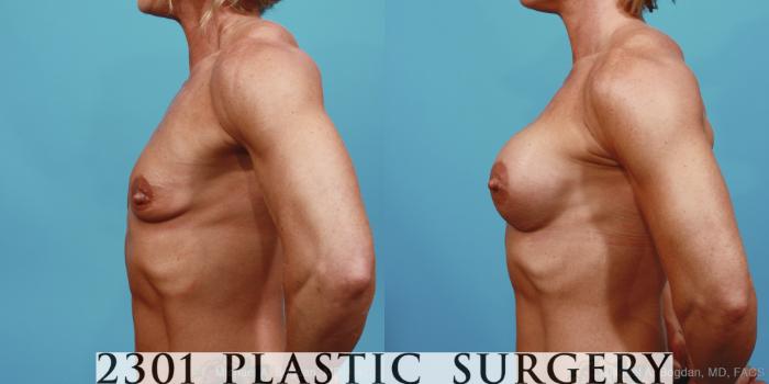 Before & After Silicone Implants Case 360 View #2 View in Fort Worth, Plano, & Frisco, Texas