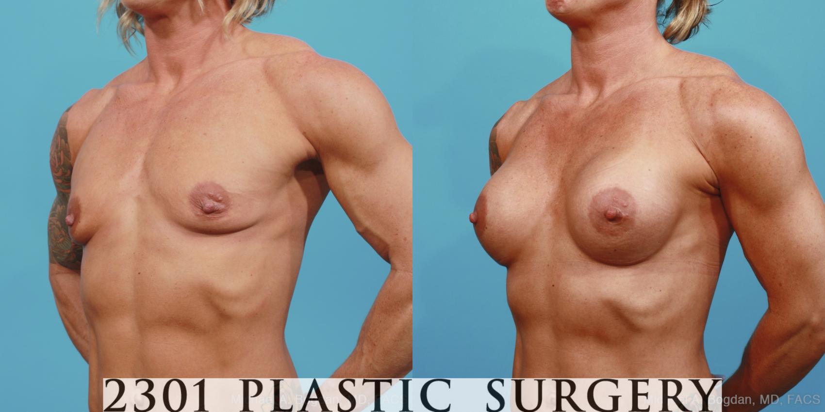 Before & After Silicone Implants Case 360 View #3 View in Fort Worth & Frisco, Texas