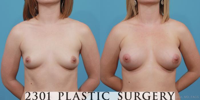Before & After Silicone Implants Case 362 View #1 View in Fort Worth, Plano, & Frisco, Texas
