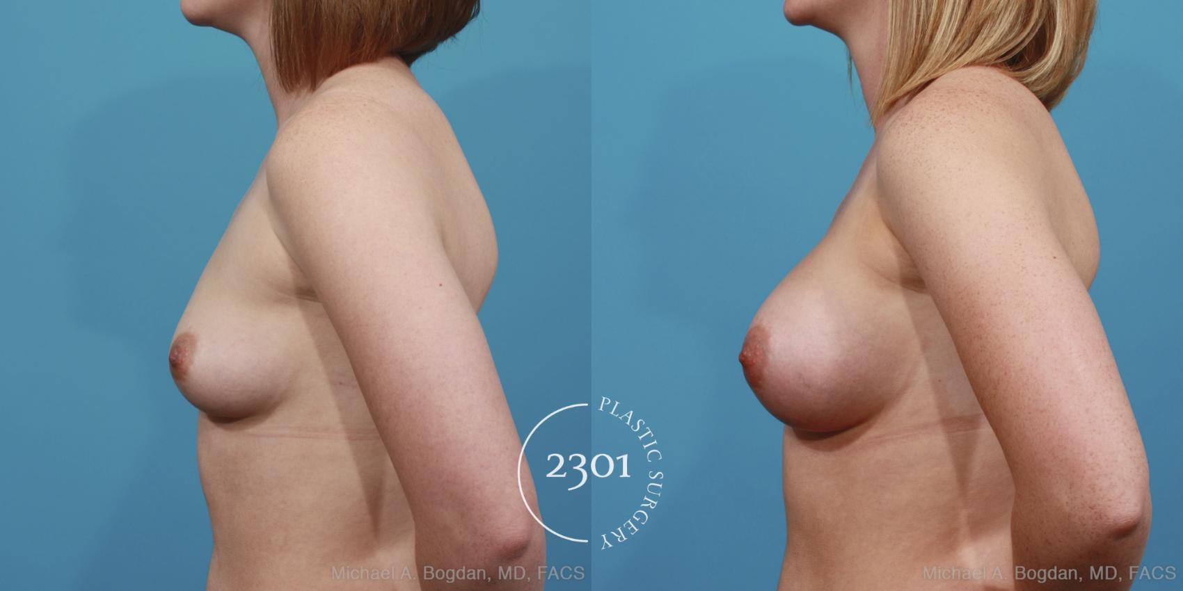 Before & After Silicone Implants Case 362 View #2 View in Fort Worth, Plano, & Frisco, Texas