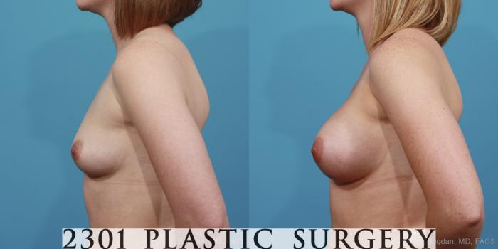 Before & After Silicone Implants Case 362 View #2 View in Fort Worth, Plano, & Frisco, Texas