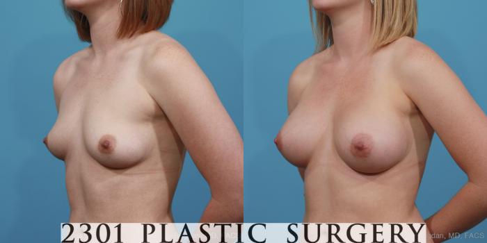 Before & After Silicone Implants Case 362 View #3 View in Fort Worth, Plano, & Frisco, Texas