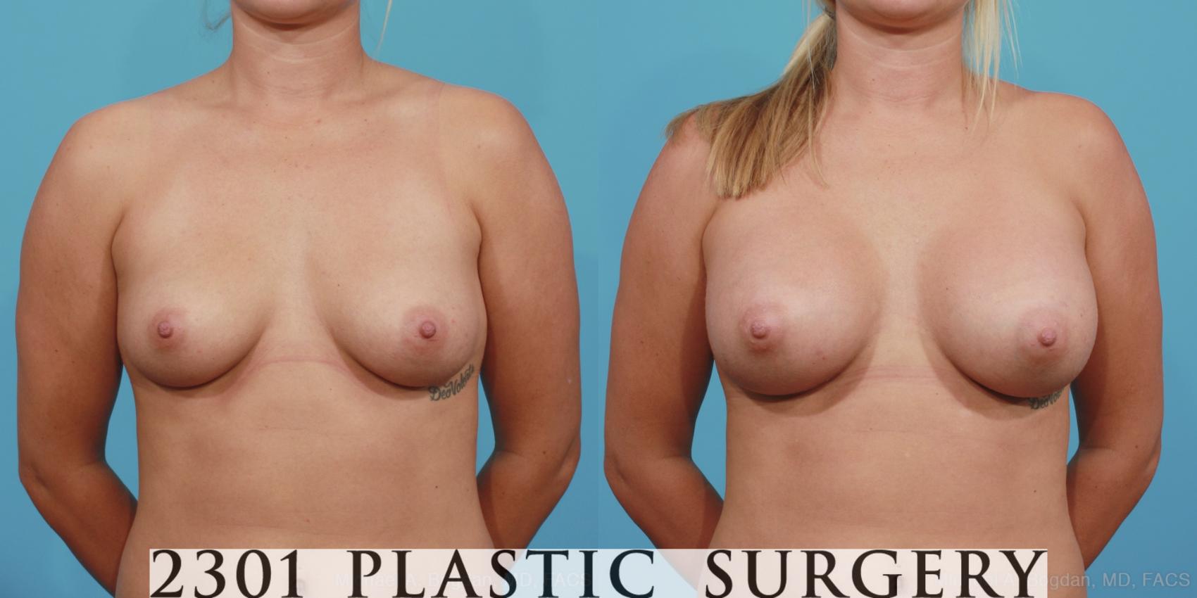 Before & After Silicone Implants Case 363 View #1 View in Fort Worth, Plano, & Frisco, Texas