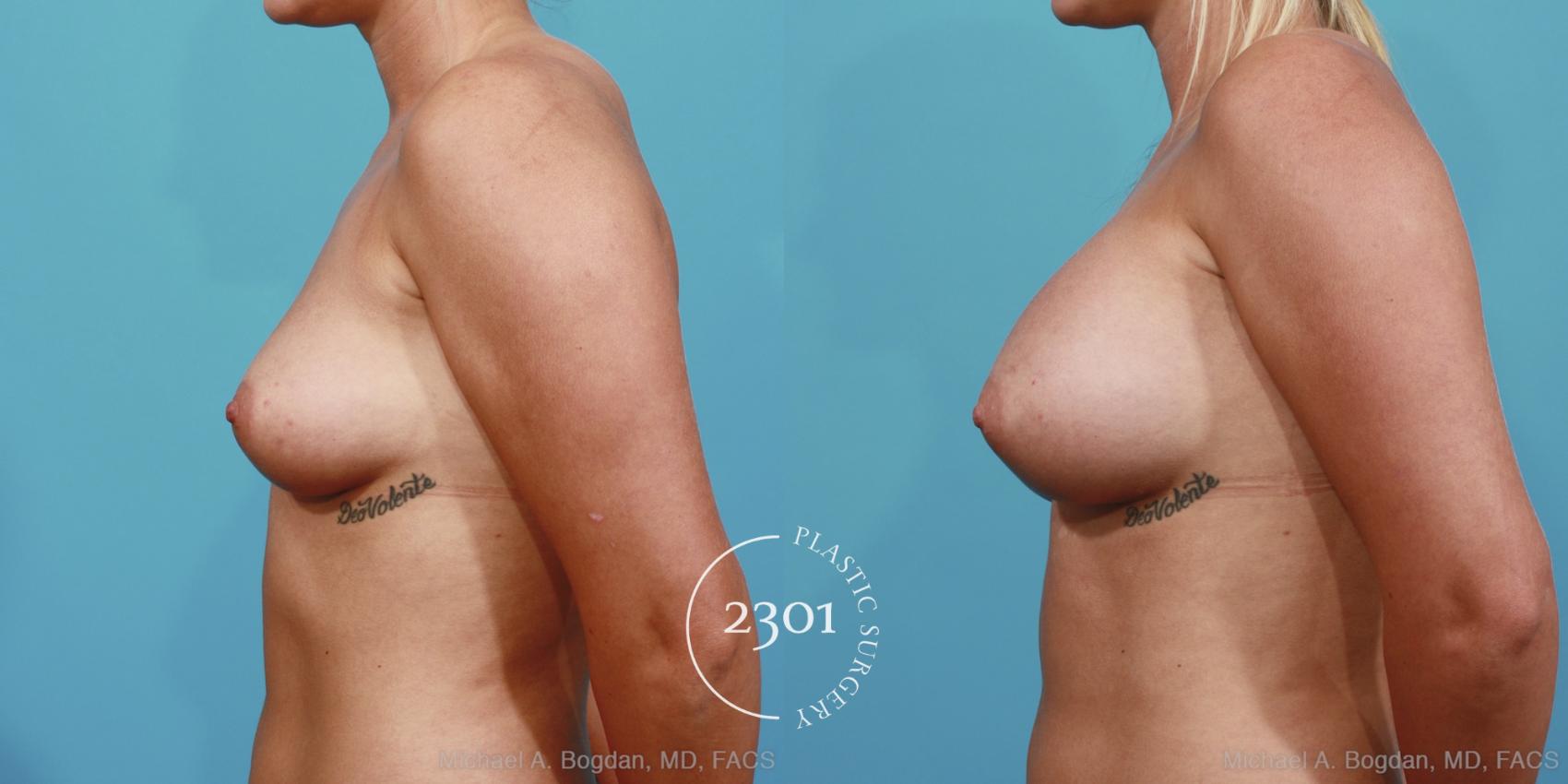 Before & After Breast Augmentation Case 363 View #2 View in Fort Worth, Plano, & Frisco, Texas