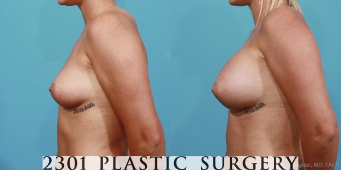 Before & After Silicone Implants Case 363 View #2 View in Fort Worth, Plano, & Frisco, Texas