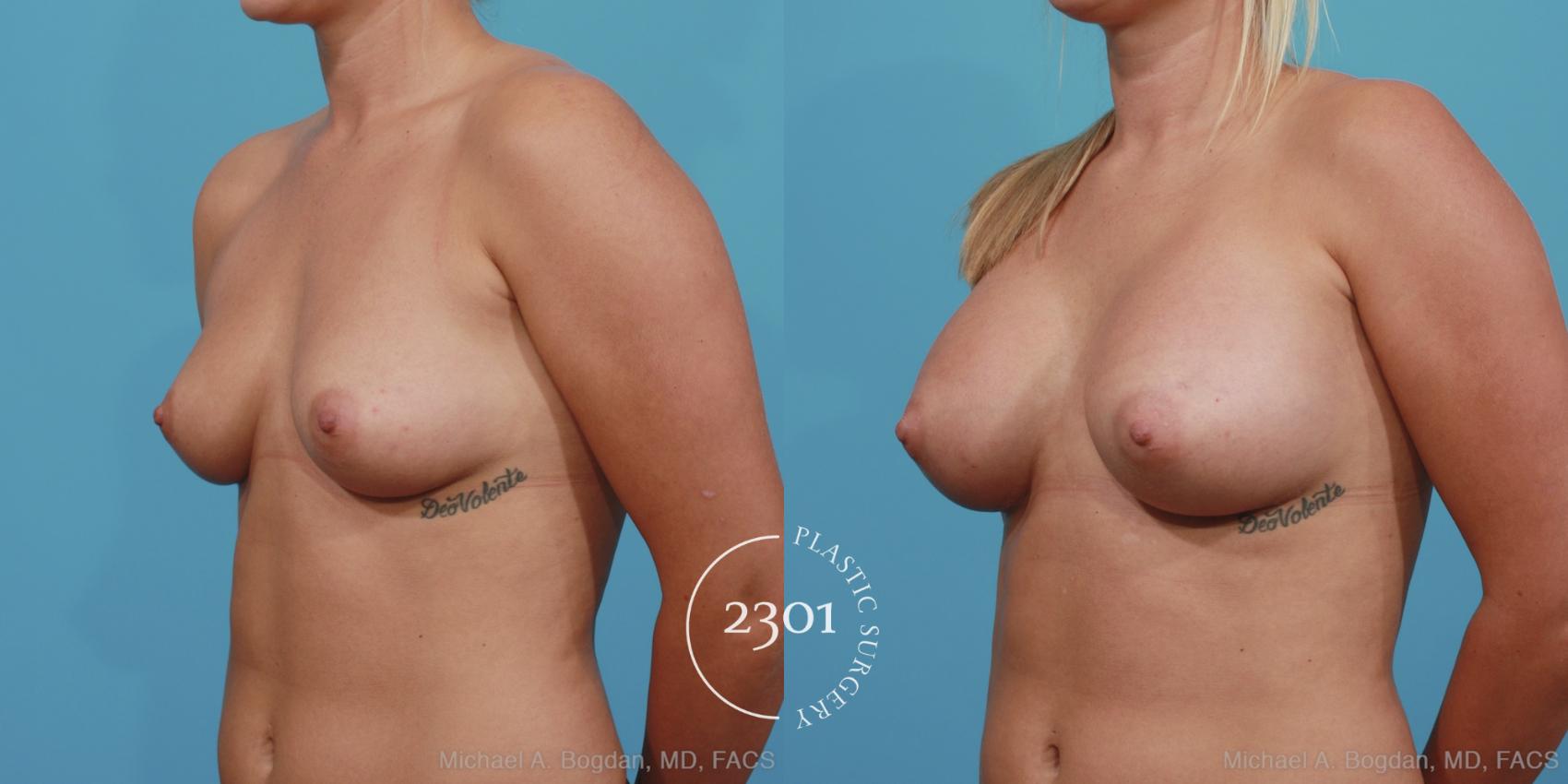 Before & After Breast Augmentation Case 363 View #3 View in Fort Worth, Plano, & Frisco, Texas