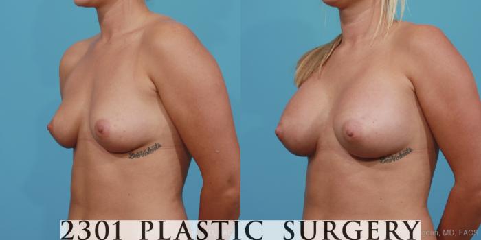 Before & After Silicone Implants Case 363 View #3 View in Fort Worth, Plano, & Frisco, Texas
