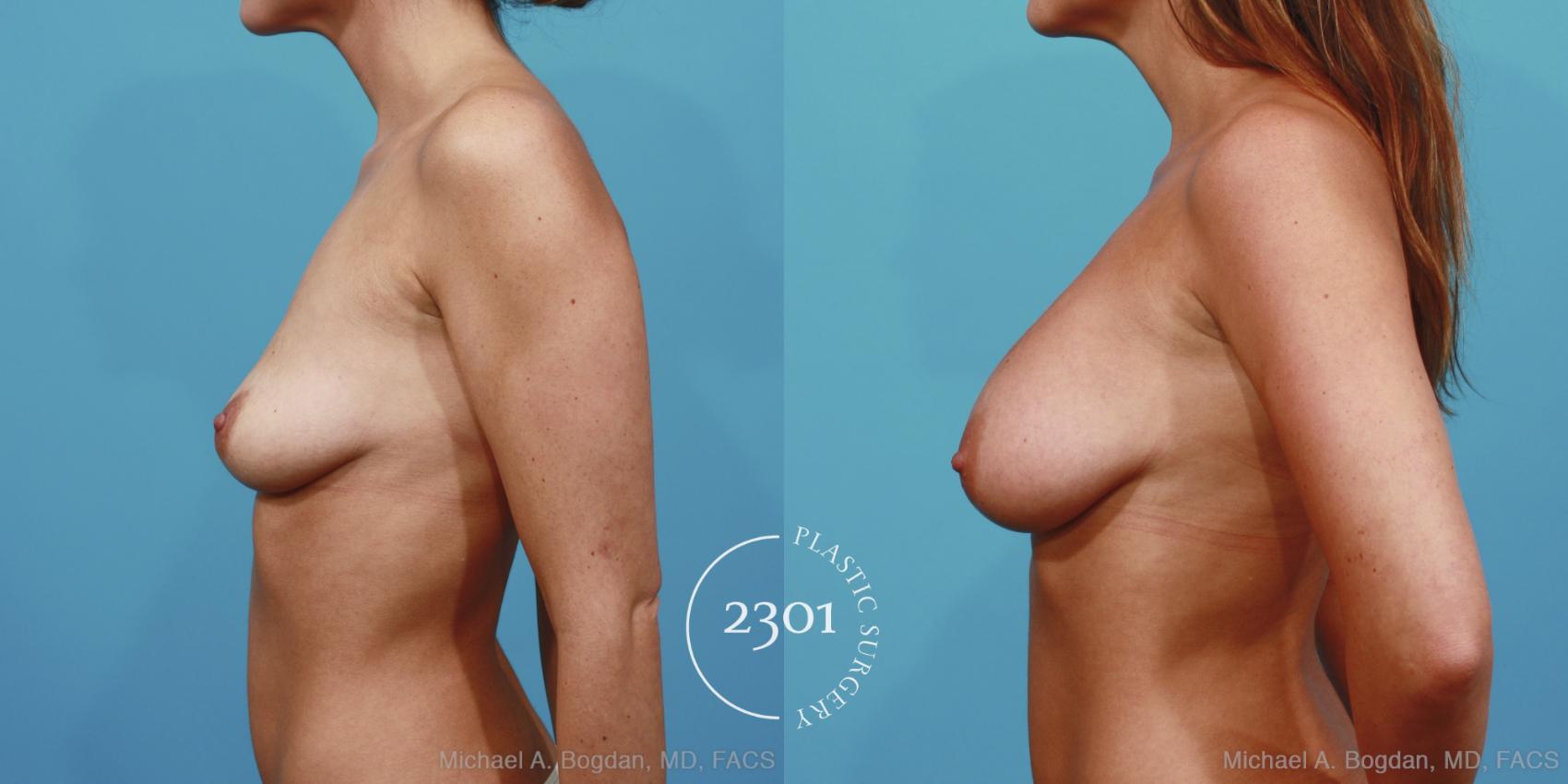 Before & After Silicone Implants Case 365 View #2 View in Fort Worth, Plano, & Frisco, Texas