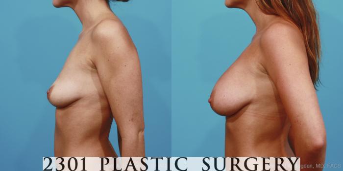 Before & After Breast Augmentation Case 365 View #2 View in Fort Worth, Plano, & Frisco, Texas
