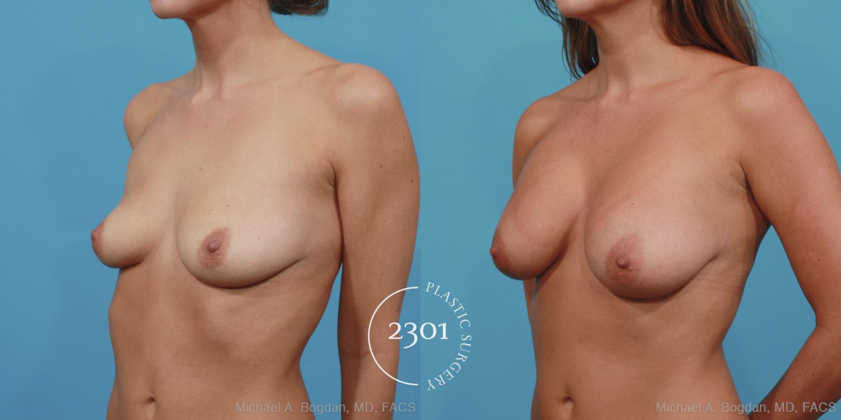 Before & After Silicone Implants Case 365 View #3 View in Fort Worth, Plano, & Frisco, Texas