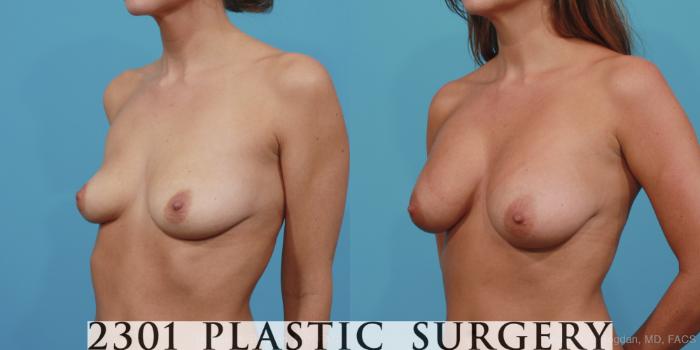Before & After Silicone Implants Case 365 View #3 View in Fort Worth, Plano, & Frisco, Texas