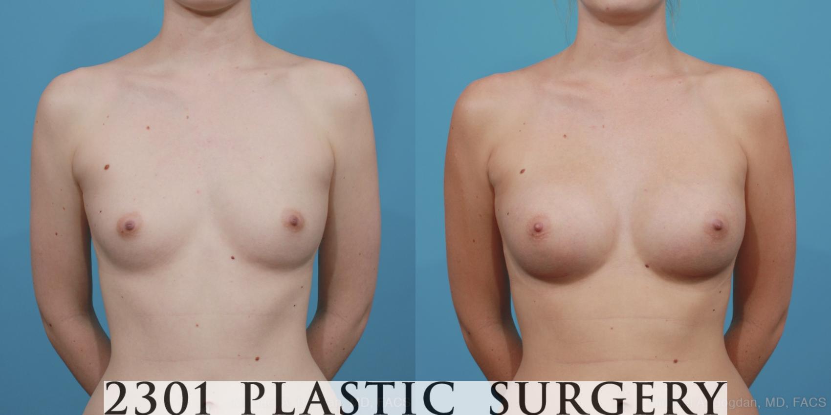 Before & After Silicone Implants Case 368 View #1 View in Fort Worth & Frisco, Texas